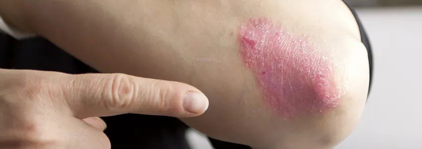Photo of skin affected by psoriasis.