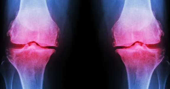 Graphic of knee joints lit up in red on an X-ray to indicate arthritis.