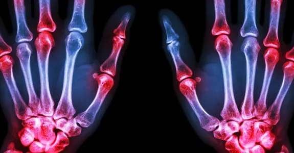 Graphic image depicting arthritis pain in hand joints.