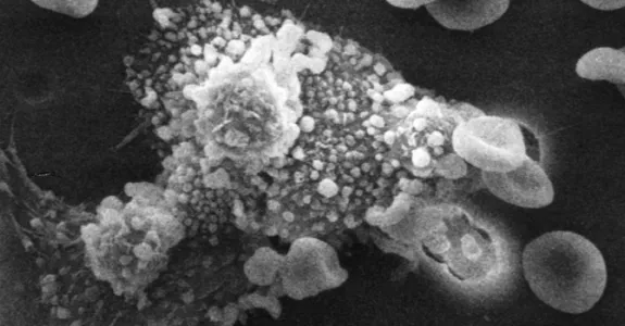 Image of macrophages beginning to fuse with, and inject toxins into, a cancer cell. The cell starts rounding up and loses its spikes.