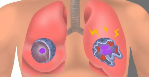 Graphic illustration showing lungs with inflamed oversized cells.