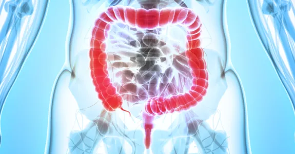 Graphic image showing large intesting lit up in red on a blue anatomical diagram.