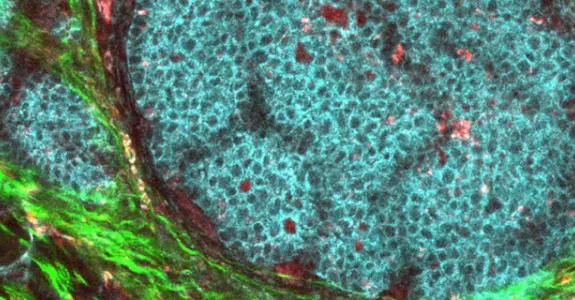 Image with large central turquoise-blue area surrounded by green, speckled by red cancer cells.