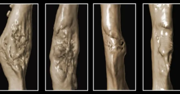 Image of mice bones forming calluses to heal, with bones in diabetic mice forming smaller calluses.