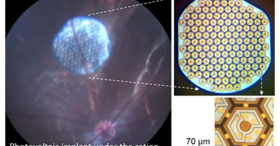Images of Dr. Daniel Palanker's retinal implant.
