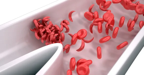 Graphic image of sickle cell blood cells in a vessel.