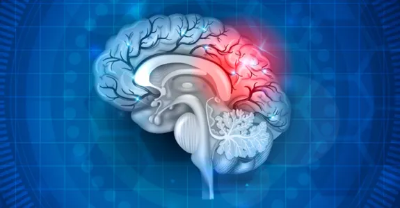 Graphic image of a human brain with one part highlighted in red to indicate stroke or damage.