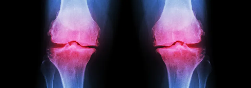 Graphic of knee joints lit up in red on an X-ray to indicate arthritis.