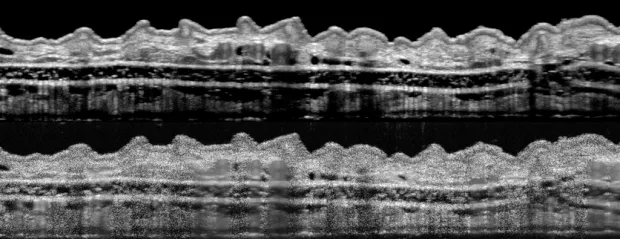 Image of two scans of the same scan of a mouse's ear, with the bottom having significantly finer resolution.