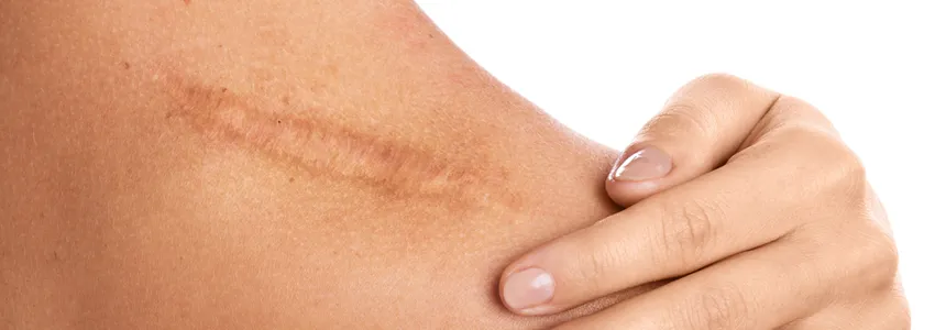 Photo of a person laying their hand on their shoulder next to a large scar.