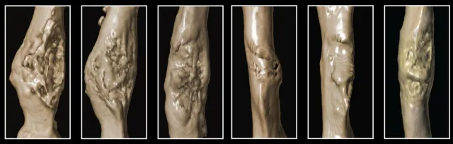 Image of mice bones forming calluses to heal, with bones in diabetic mice forming smaller calluses.