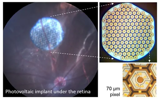 Images of Dr. Daniel Palanker's retinal implant.