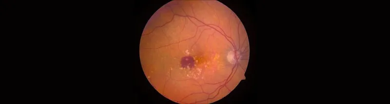 Image of eye affected by AMD.