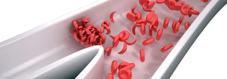 Graphic image of sickle cell blood cells in a vessel.